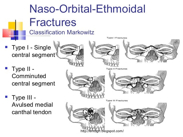 Facial fracture classification galleries 808